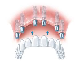 Dental Implants in Lucknow​